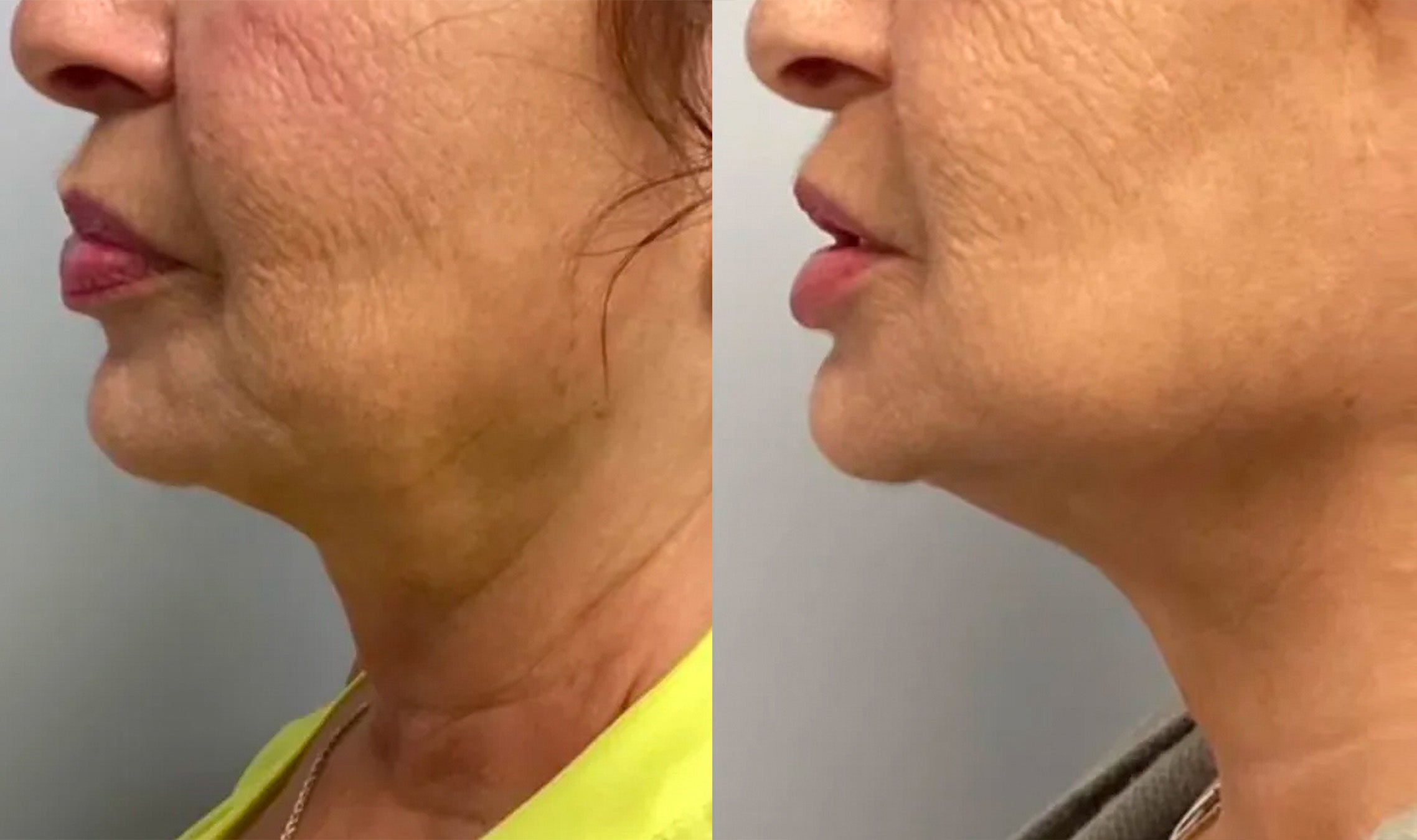The Wrinkle Retreat 2.0™ Clinical Protocol: The Complete 4 Step Cortisol-Repair System